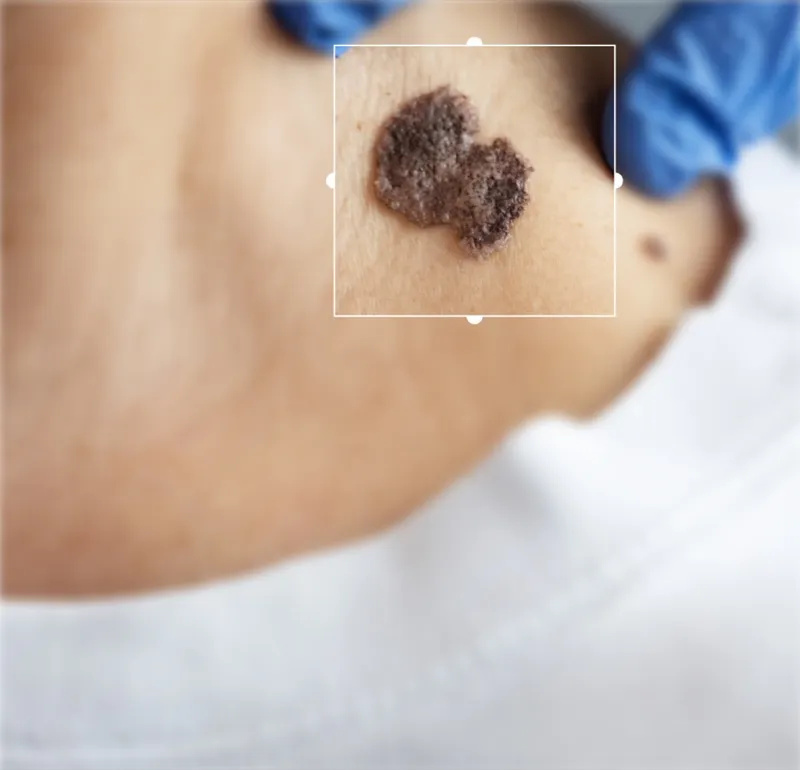 Skin Cancer